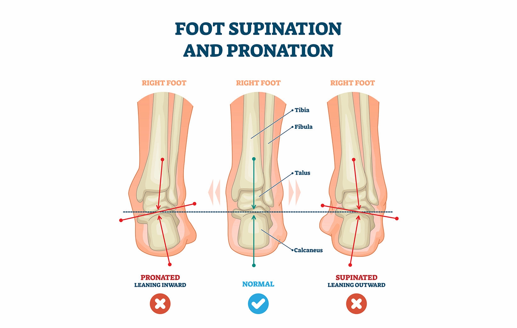 Pedag-CORRECT PLUS | over-supination insole